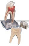 Upper Triple-Root Molar, 3 part